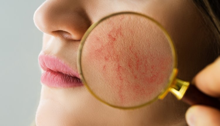 vrouw met rosacea