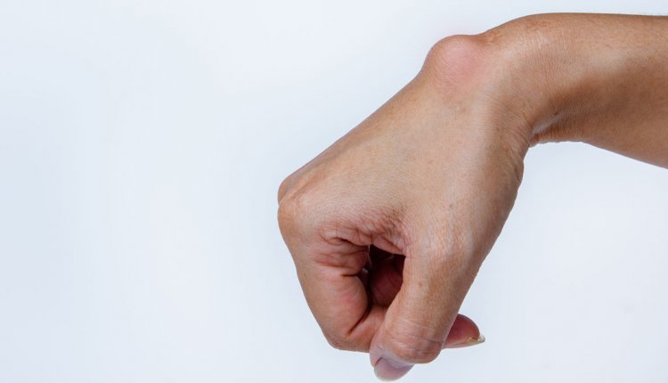 Hand met bobbel op de pols