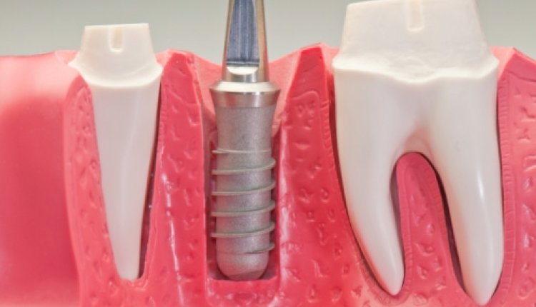Implantaten