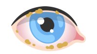 Ooglidontsteking