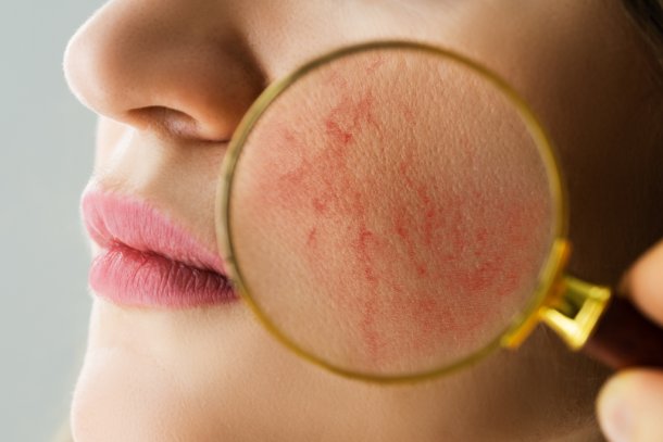 vrouw met rosacea