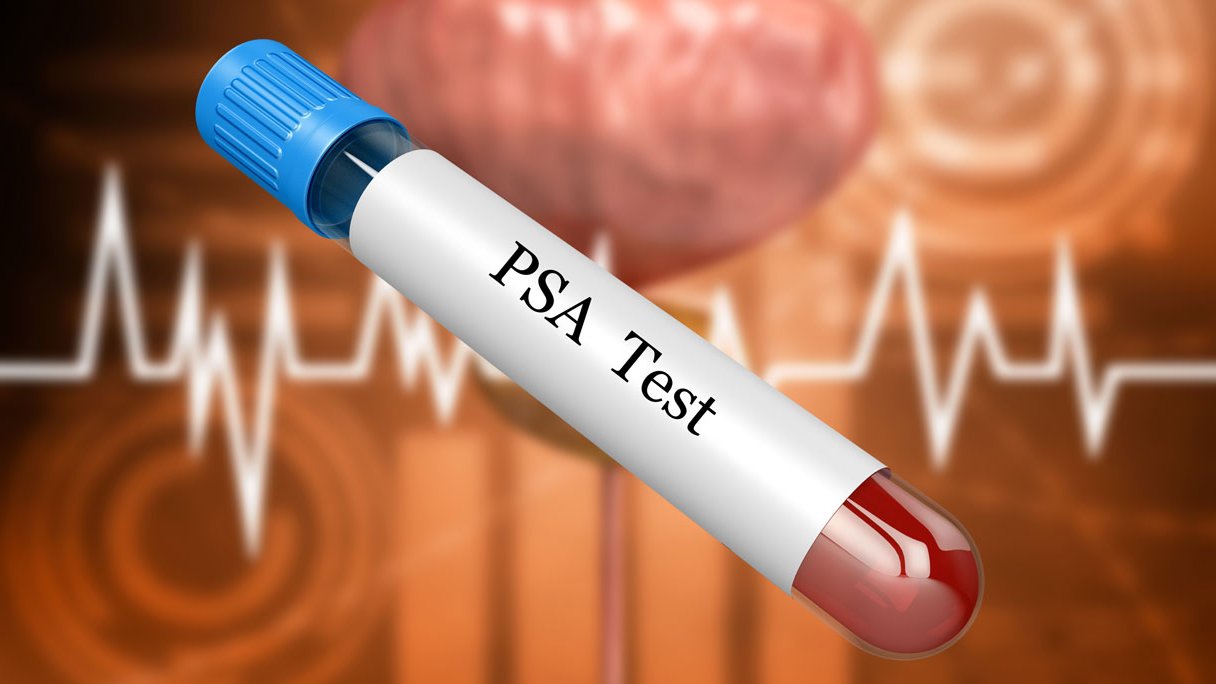 Wat is een normale PSA-waarde? | PlusOnline