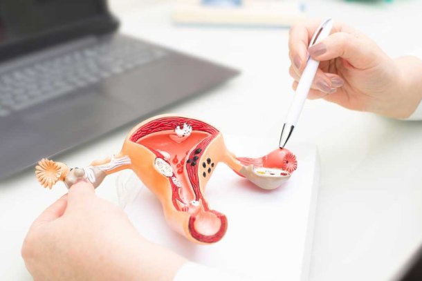 endometriose