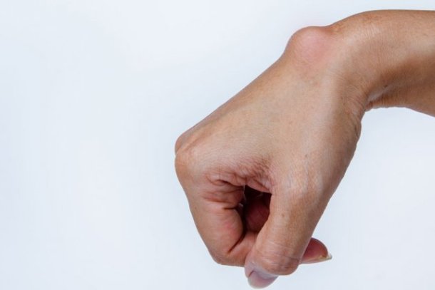 Hand met bobbel op de pols